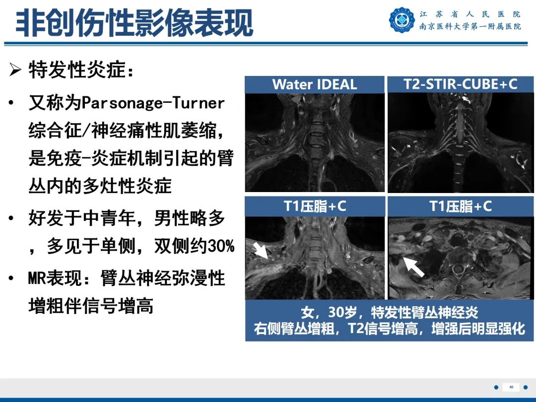 影像PPT - 【PPT】臂丛病变-41