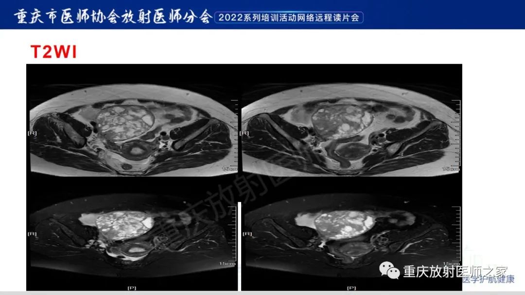 影像PPT - 【病例】卵巢颗粒细胞瘤1例MR影像-4