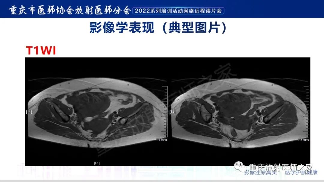影像PPT - 【病例】卵巢颗粒细胞瘤1例MR影像-3