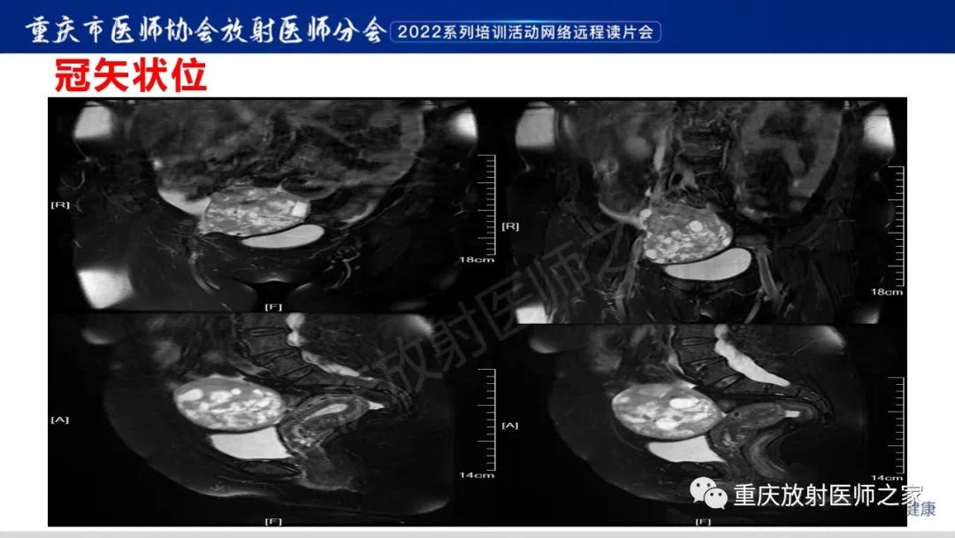 影像PPT - 【病例】卵巢颗粒细胞瘤1例MR影像-5