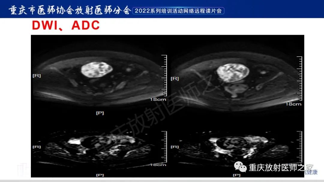 影像PPT - 【病例】卵巢颗粒细胞瘤1例MR影像-6