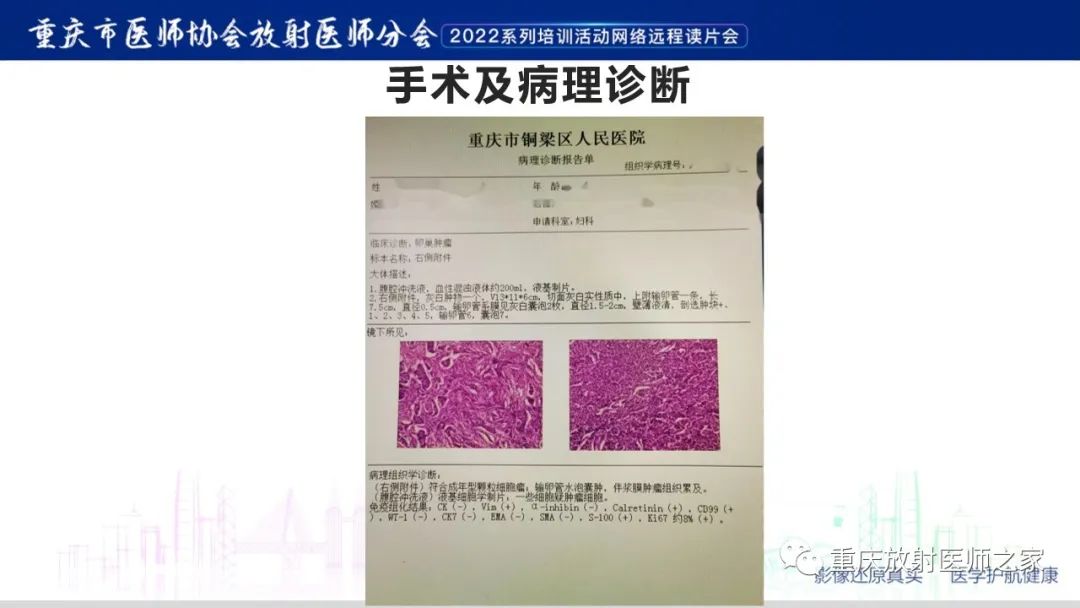 影像PPT - 【病例】卵巢颗粒细胞瘤1例MR影像-10