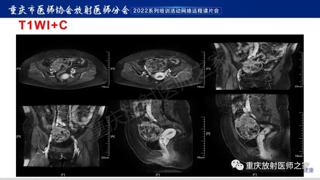 影像PPT - 【病例】卵巢颗粒细胞瘤1例MR影像-7