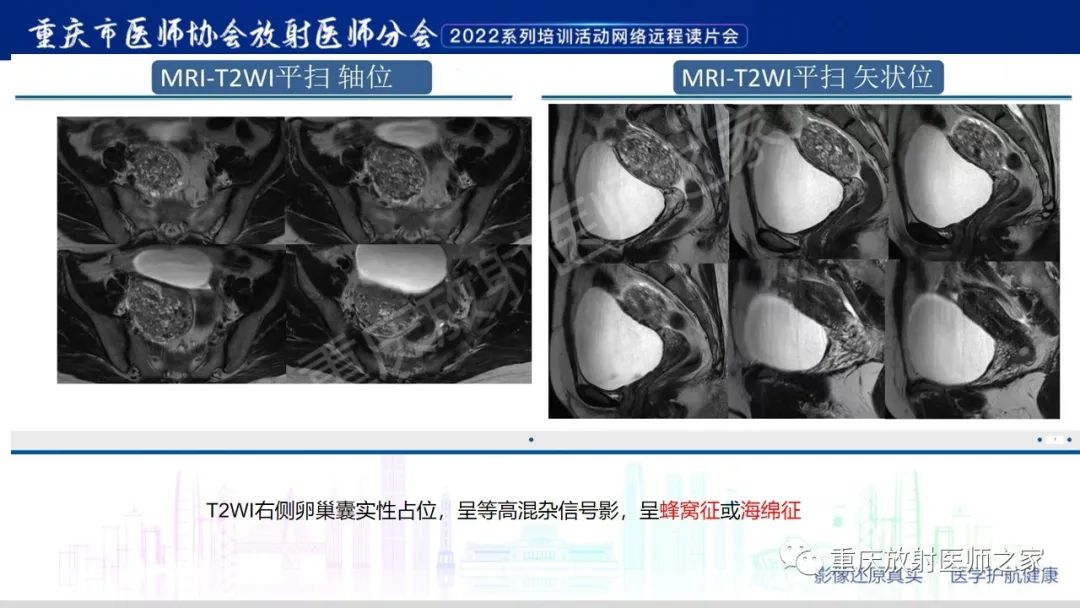 影像PPT - 【病例】卵巢颗粒细胞瘤1例MR影像-16