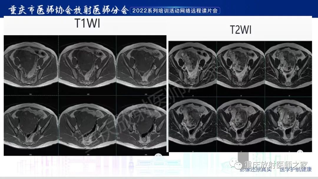 影像PPT - 【病例】卵巢颗粒细胞瘤1例MR影像-14