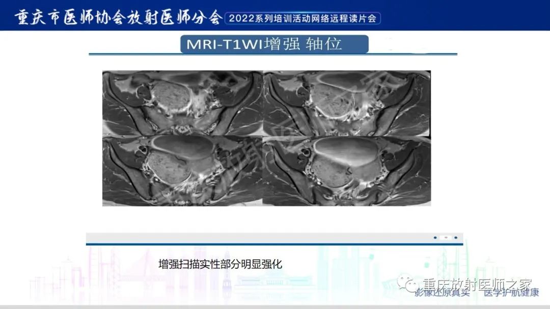 影像PPT - 【病例】卵巢颗粒细胞瘤1例MR影像-17