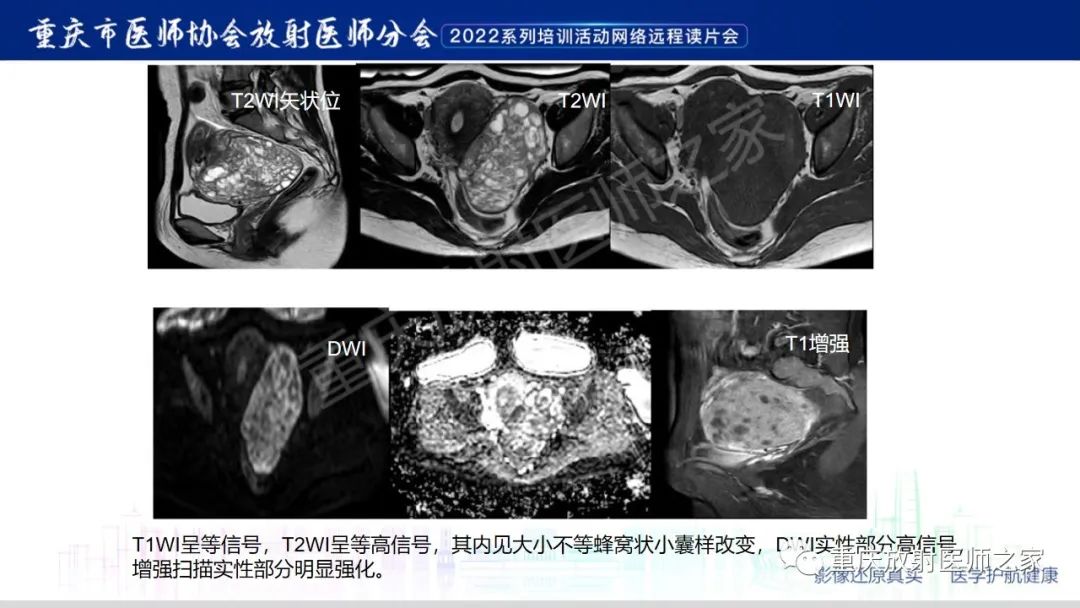 影像PPT - 【病例】卵巢颗粒细胞瘤1例MR影像-18