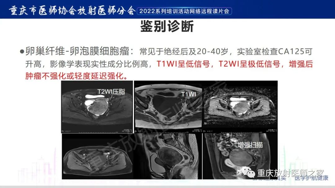 影像PPT - 【病例】卵巢颗粒细胞瘤1例MR影像-19