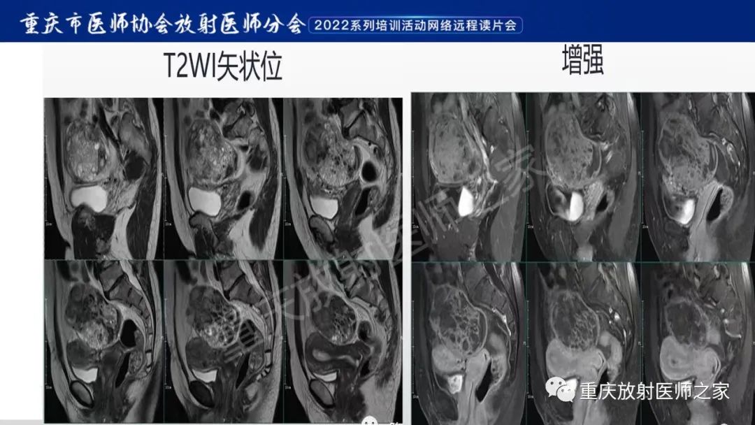 影像PPT - 【病例】卵巢颗粒细胞瘤1例MR影像-15