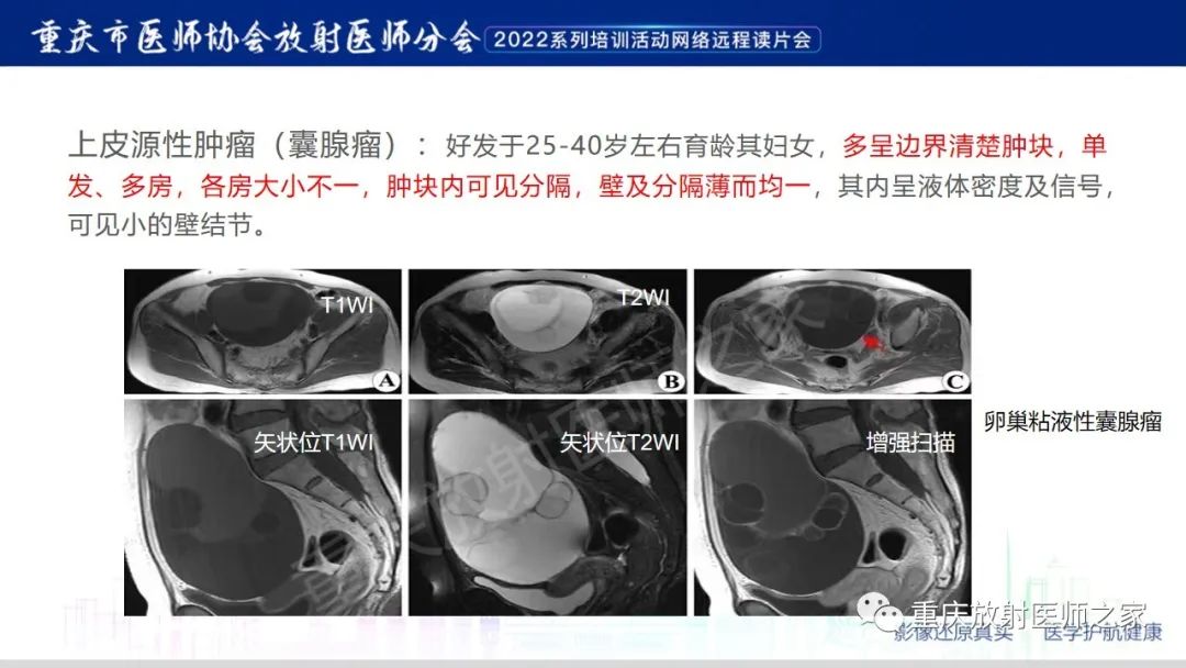 影像PPT - 【病例】卵巢颗粒细胞瘤1例MR影像-20