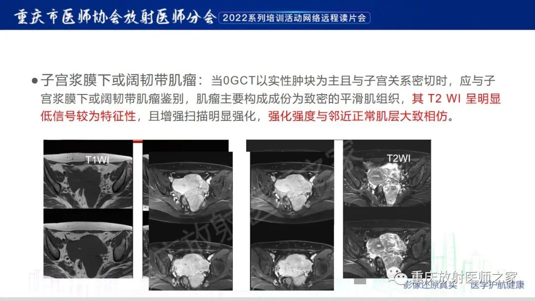 影像PPT - 【病例】卵巢颗粒细胞瘤1例MR影像-22
