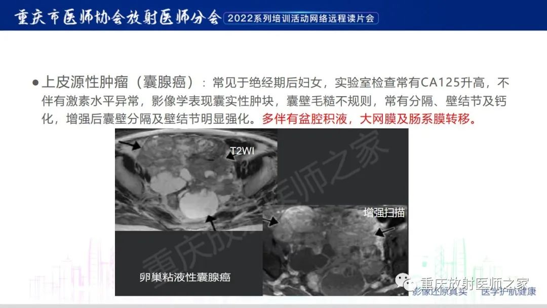 影像PPT - 【病例】卵巢颗粒细胞瘤1例MR影像-21