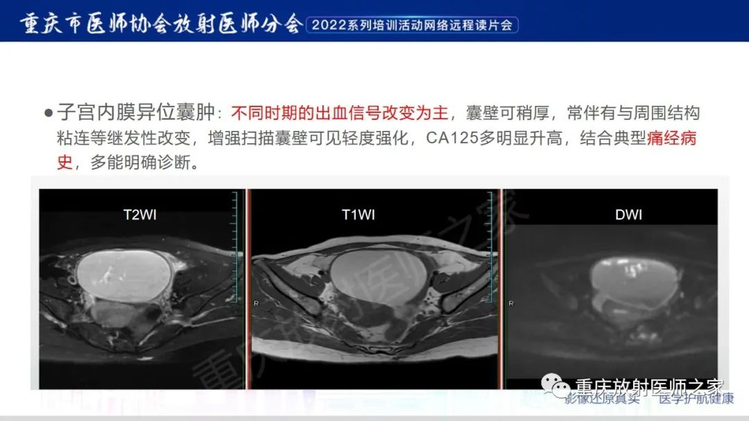 影像PPT - 【病例】卵巢颗粒细胞瘤1例MR影像-23