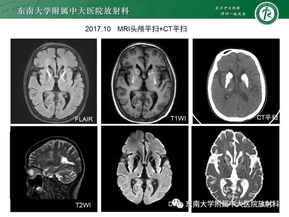 影像PPT - 【PPT】成人颅内T1WI高信号病例随访-7