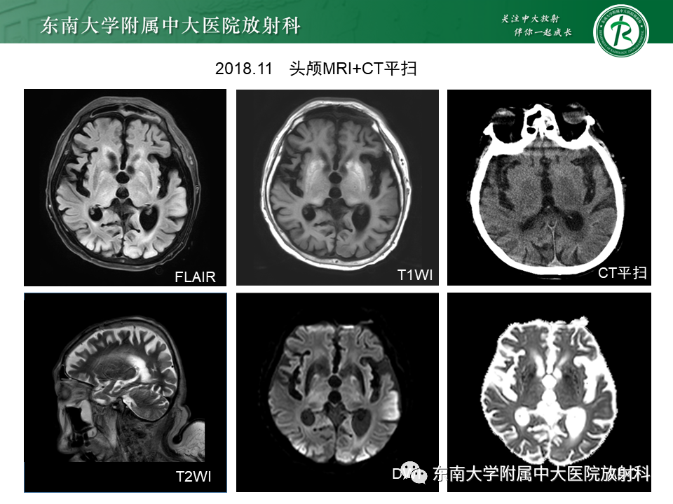 影像PPT - 【PPT】成人颅内T1WI高信号病例随访-10