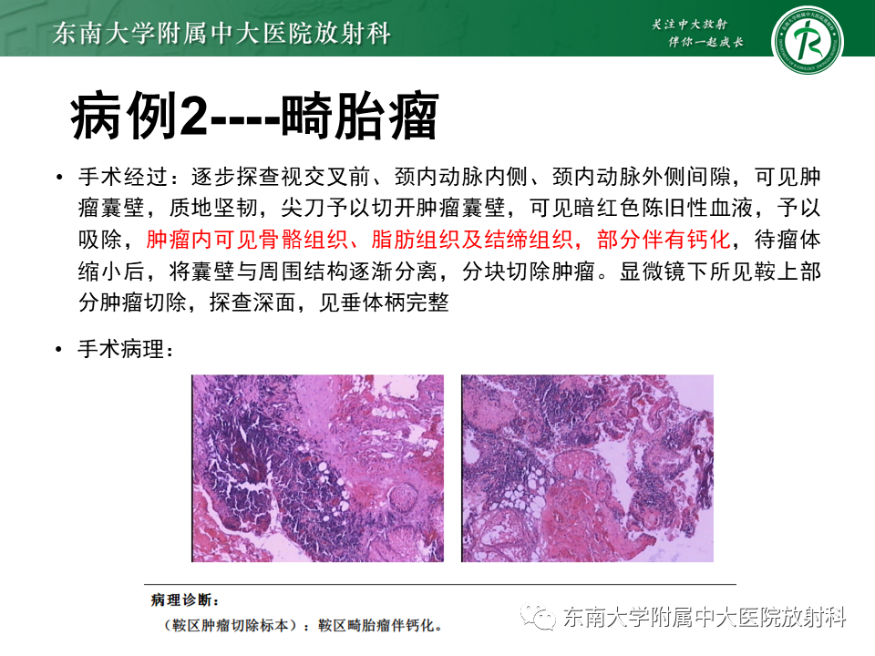影像PPT - 【PPT】成人颅内T1WI高信号病例随访-12