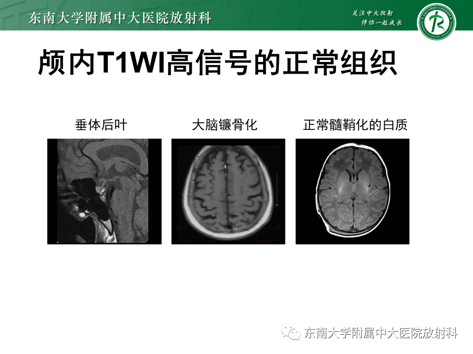 影像PPT - 【PPT】成人颅内T1WI高信号病例随访-23