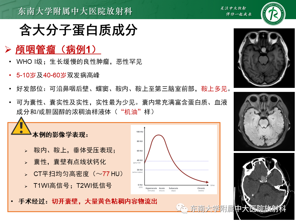 影像PPT - 【PPT】成人颅内T1WI高信号病例随访-28