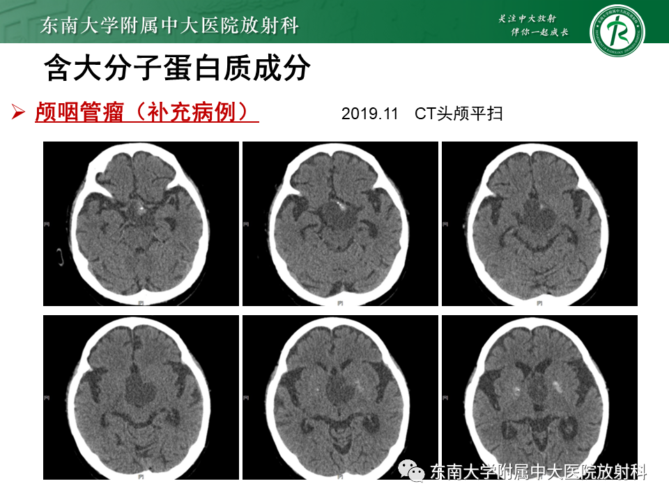 影像PPT - 【PPT】成人颅内T1WI高信号病例随访-30