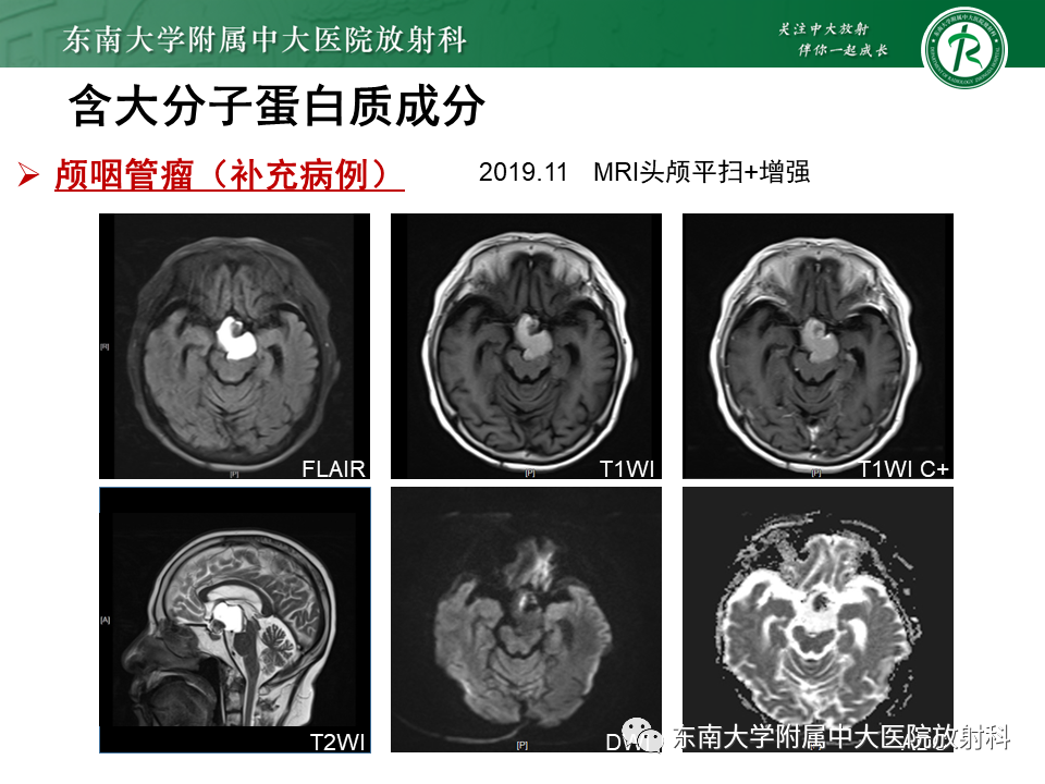 影像PPT - 【PPT】成人颅内T1WI高信号病例随访-31