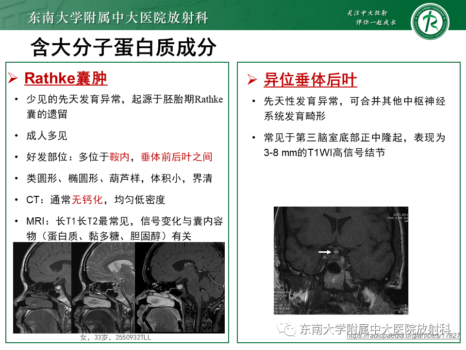 影像PPT - 【PPT】成人颅内T1WI高信号病例随访-35