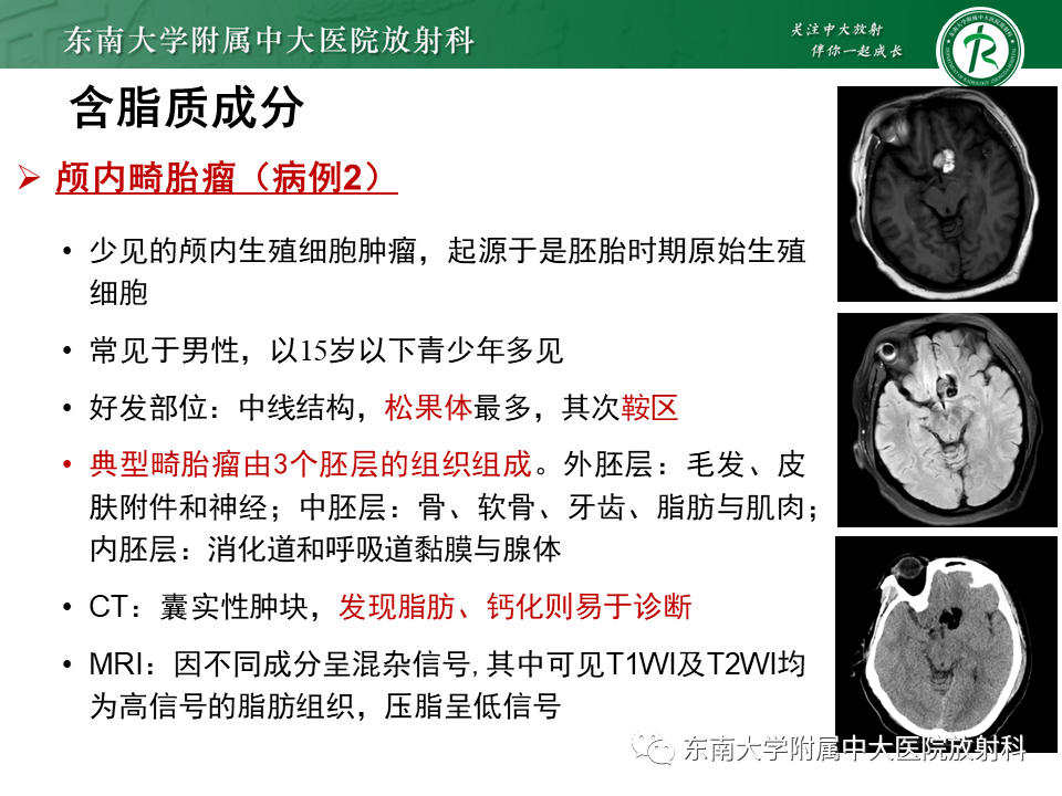影像PPT - 【PPT】成人颅内T1WI高信号病例随访-38