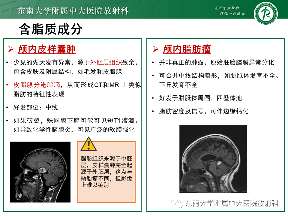 影像PPT - 【PPT】成人颅内T1WI高信号病例随访-39