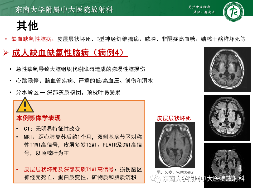 影像PPT - 【PPT】成人颅内T1WI高信号病例随访-50