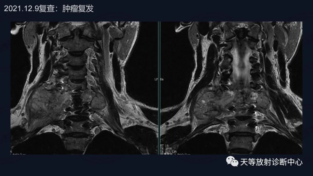 影像PPT - 【病例】颈椎脊柱软骨肉瘤1例CT及MR影像-11 影像PPT - 【病例】颈椎脊柱软骨肉瘤1例CT及MR影像-11