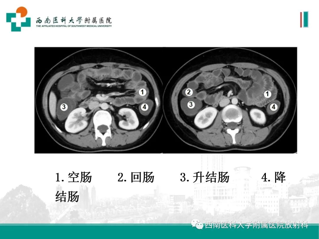 影像PPT - 【PPT】小肠CT检查技术及后处理-6