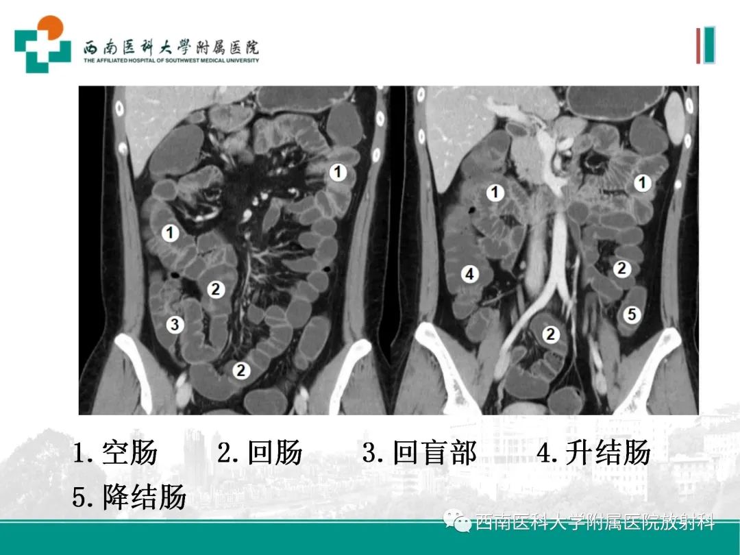 影像PPT - 【PPT】小肠CT检查技术及后处理-7