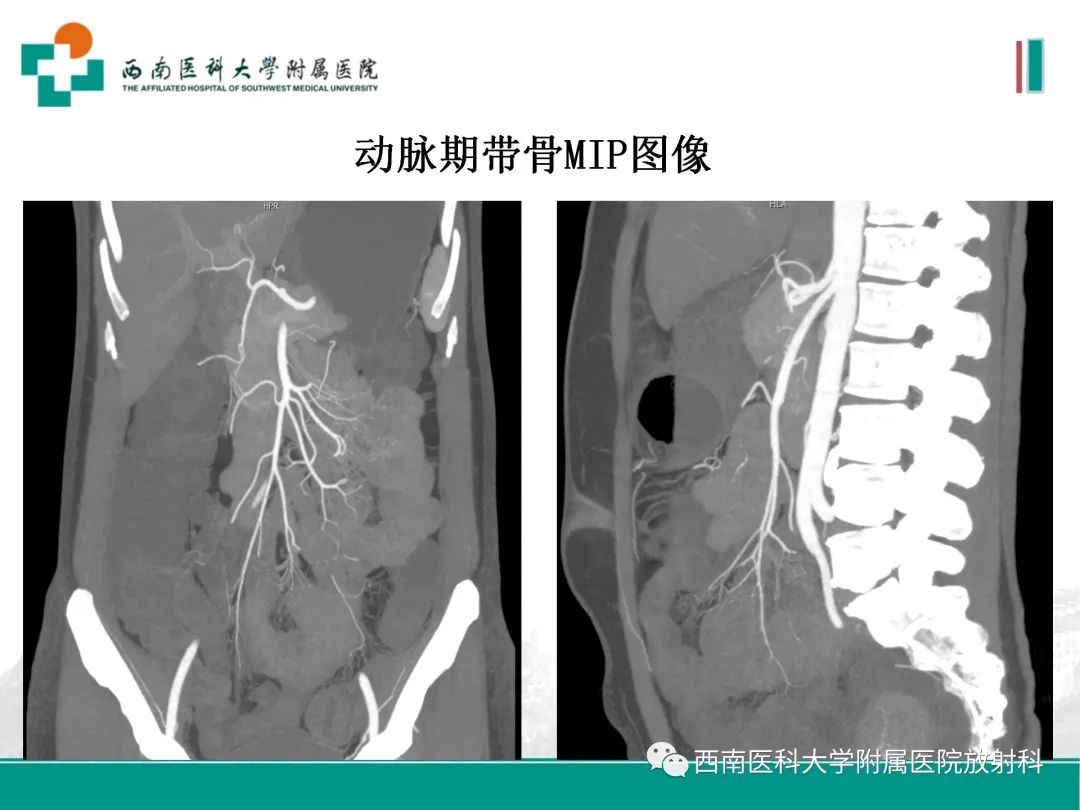 影像PPT - 【PPT】小肠CT检查技术及后处理-16