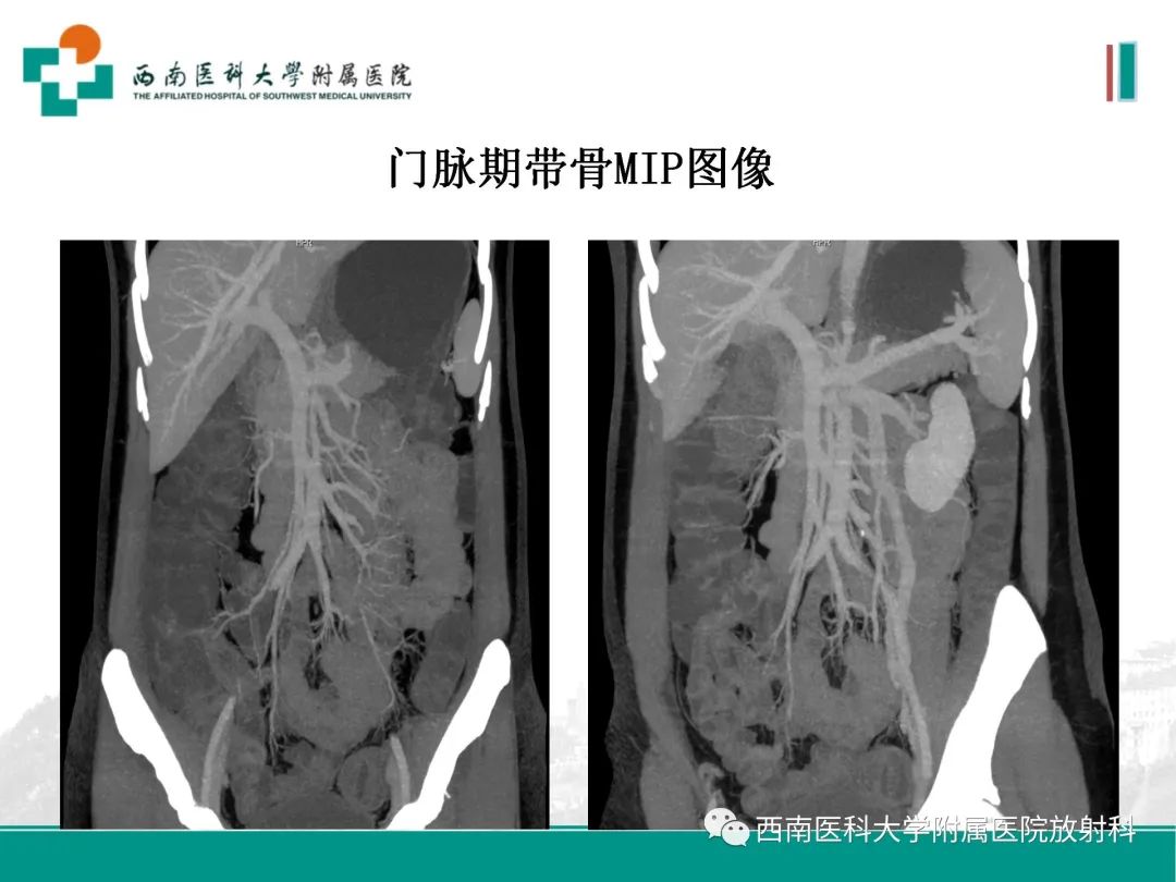 影像PPT - 【PPT】小肠CT检查技术及后处理-17