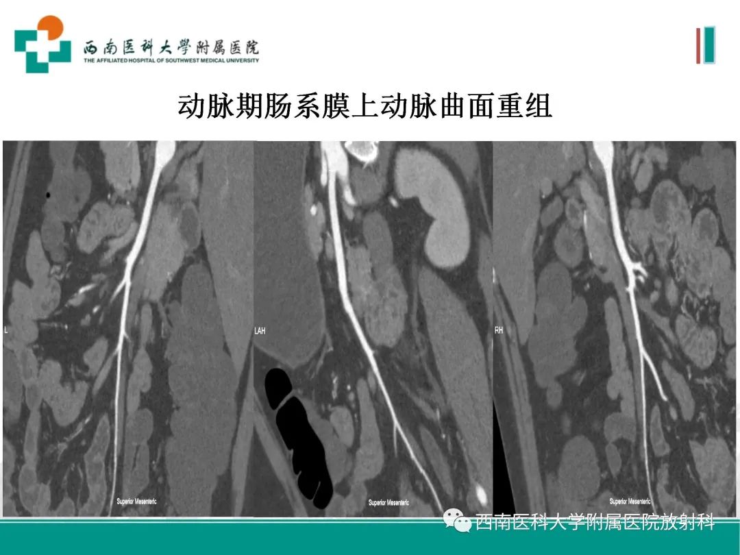 影像PPT - 【PPT】小肠CT检查技术及后处理-18