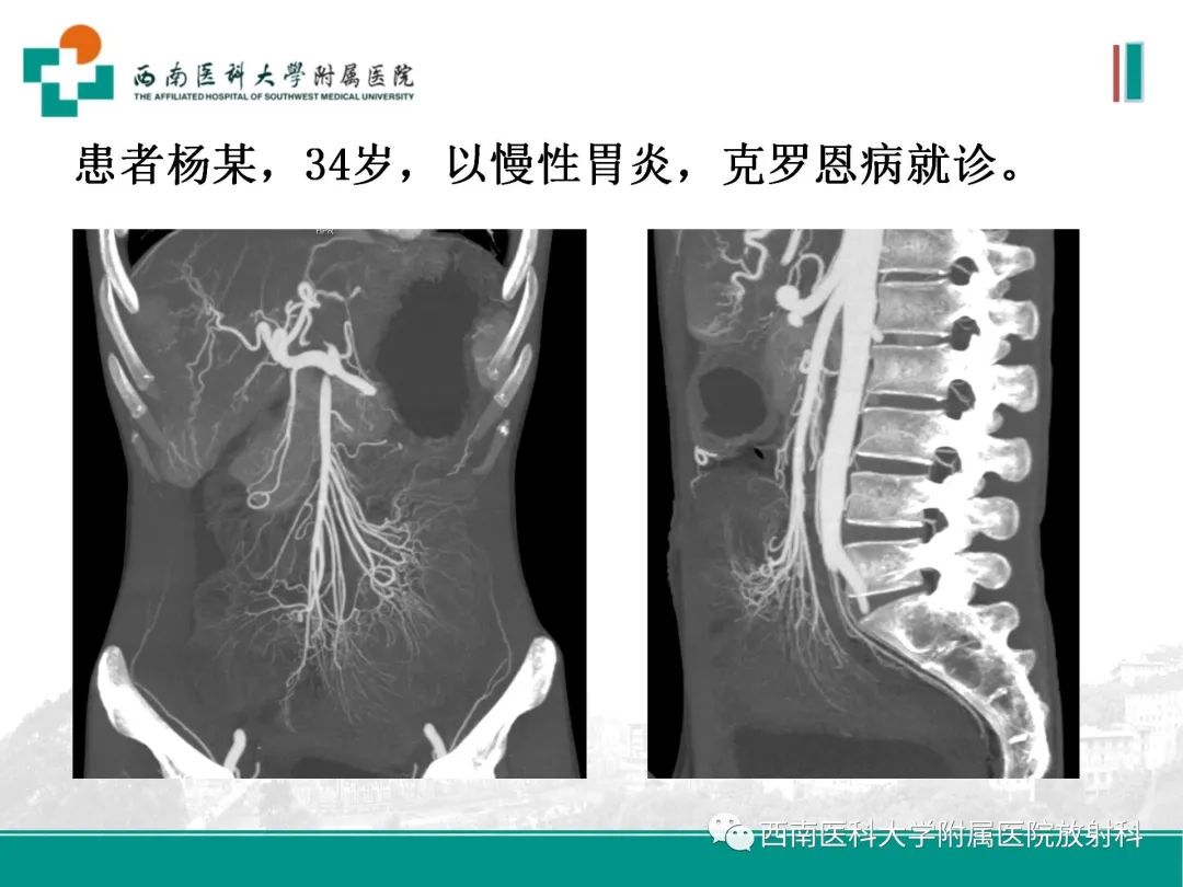 影像PPT - 【PPT】小肠CT检查技术及后处理-20