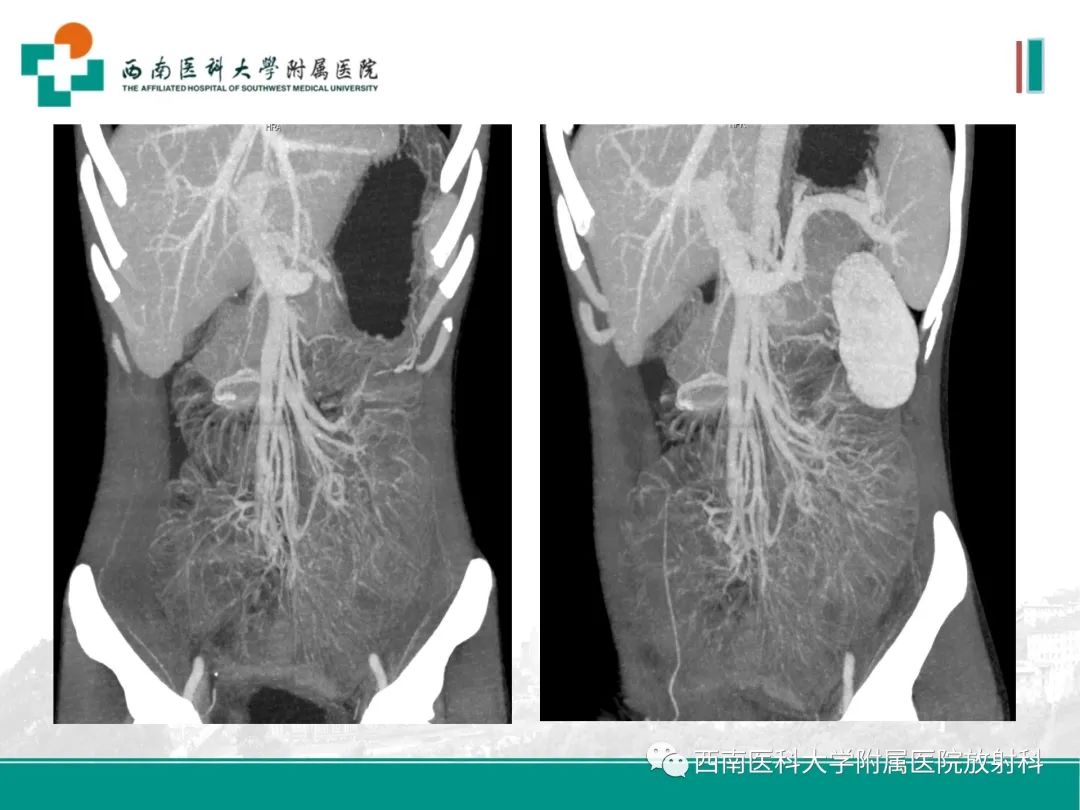 影像PPT - 【PPT】小肠CT检查技术及后处理-21