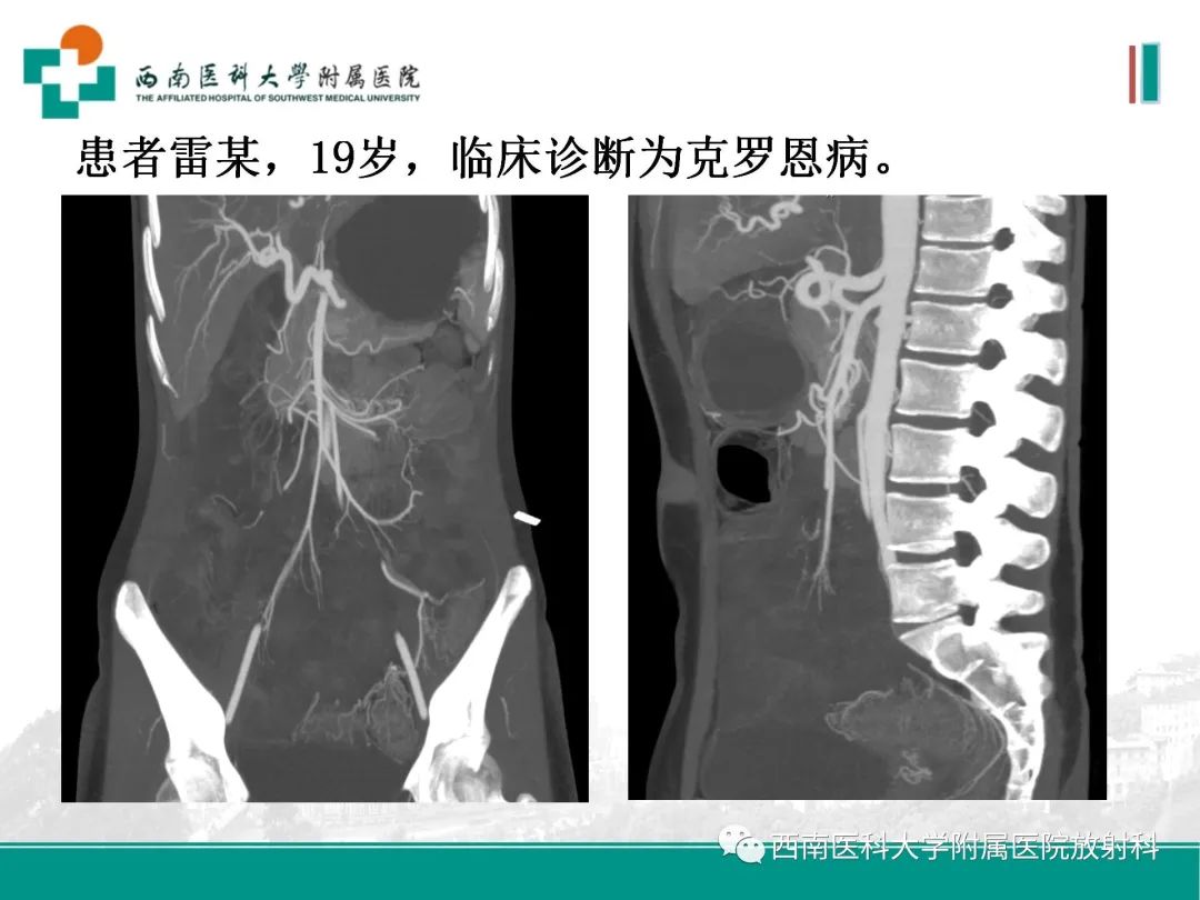 影像PPT - 【PPT】小肠CT检查技术及后处理-23