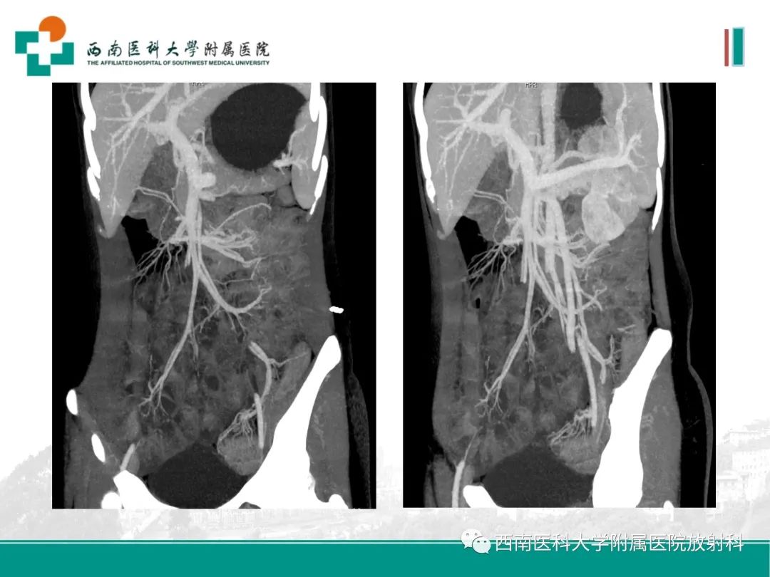 影像PPT - 【PPT】小肠CT检查技术及后处理-24