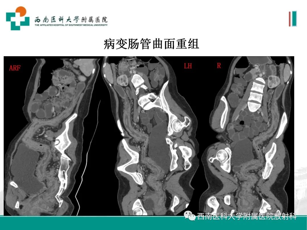 影像PPT - 【PPT】小肠CT检查技术及后处理-25