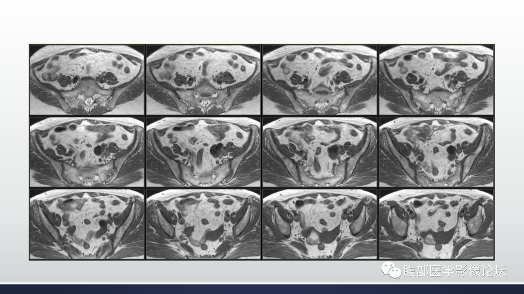 影像PPT - 【病例】膀胱非浸润性低级别乳头状尿路上皮癌1例MR影像-7