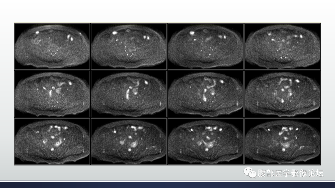 影像PPT - 【病例】膀胱非浸润性低级别乳头状尿路上皮癌1例MR影像-11