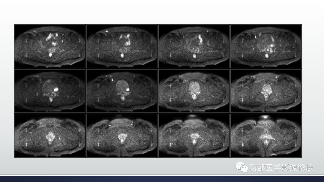 影像PPT - 【病例】膀胱非浸润性低级别乳头状尿路上皮癌1例MR影像-12