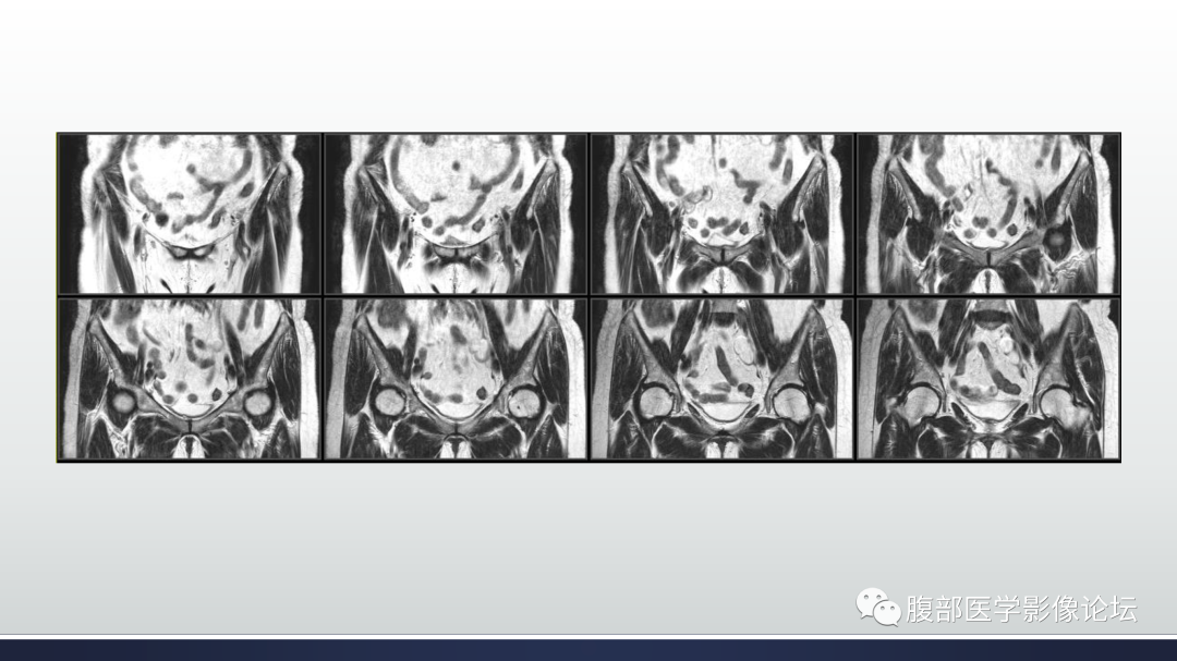 影像PPT - 【病例】膀胱非浸润性低级别乳头状尿路上皮癌1例MR影像-15