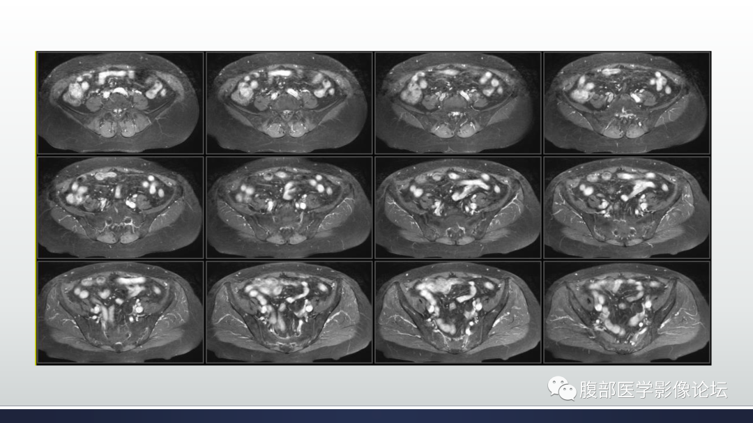 影像PPT - 【病例】膀胱非浸润性低级别乳头状尿路上皮癌1例MR影像-19