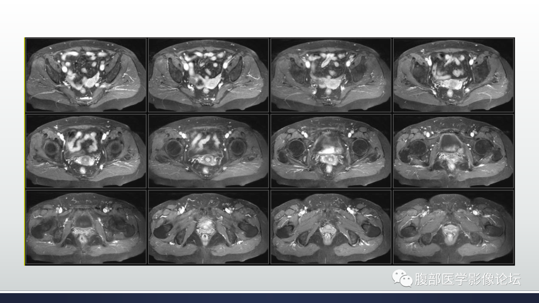 影像PPT - 【病例】膀胱非浸润性低级别乳头状尿路上皮癌1例MR影像-20