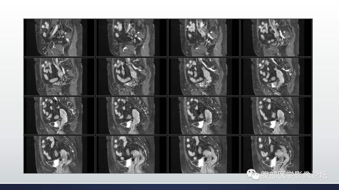 影像PPT - 【病例】膀胱非浸润性低级别乳头状尿路上皮癌1例MR影像-23
