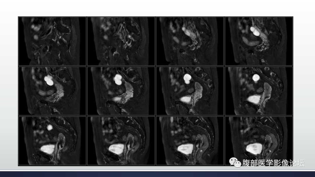 影像PPT - 【病例】膀胱非浸润性低级别乳头状尿路上皮癌1例MR影像-26