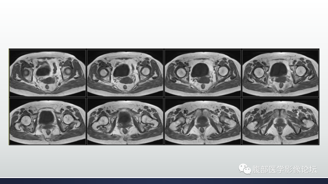 影像PPT - 【病例】膀胱非浸润性低级别乳头状尿路上皮癌1例MR影像-30