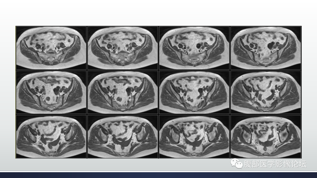 影像PPT - 【病例】膀胱非浸润性低级别乳头状尿路上皮癌1例MR影像-29
