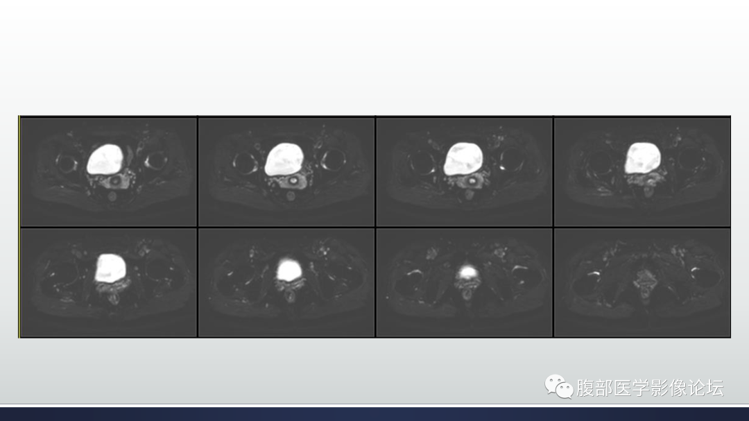 影像PPT - 【病例】膀胱非浸润性低级别乳头状尿路上皮癌1例MR影像-32